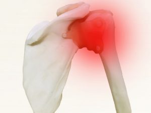 野球肩のイメージ図