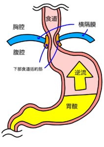 逆流性食道炎のイメージ図