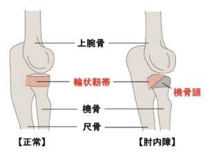 肘内障のイメージ図