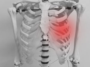 肋間神経痛のイメージ図